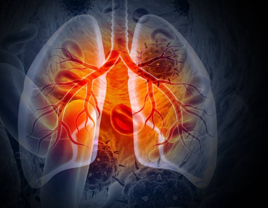 lung cancer project preview